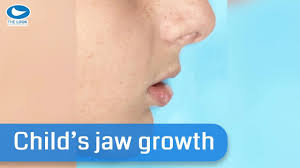 When Does Jaw Stop Growing: A Guide To Facial Development