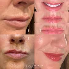 Does Filler Dissolve Or Migrate | Do Fillers Move Or Dissolve?